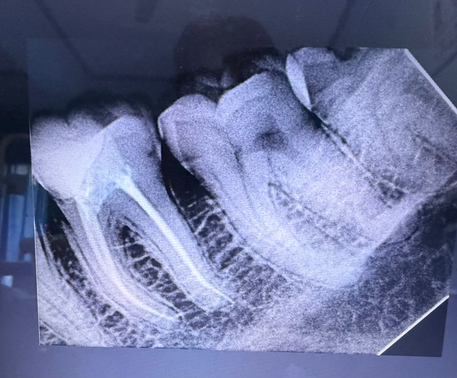 single visit root canal treatment (RCT)